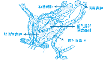 前列腺囊肿分为哪几种类型